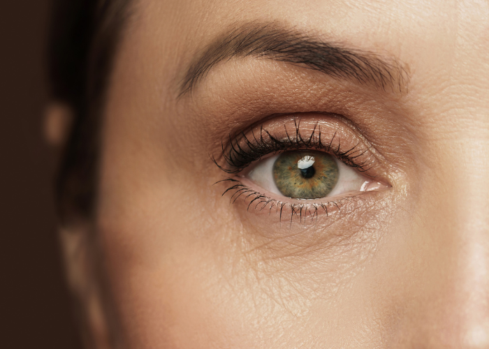 Juvederm effect: under-eye rejuvenation