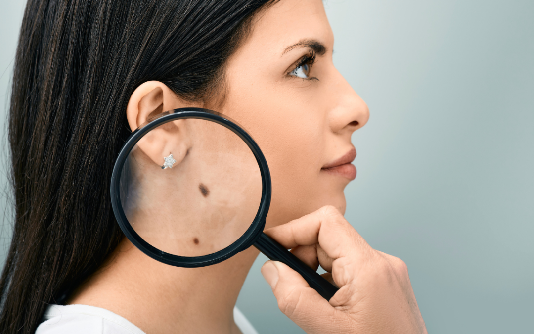 Symptoms That Show You Could Need a Skin Cancer Treatment Orland Park